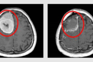 婦人頭痛視力模糊 腦內發現9公分腦瘤 手術後順利「拆彈」